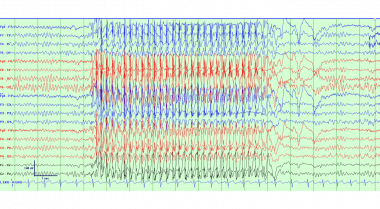 absence seizure eeg usmle