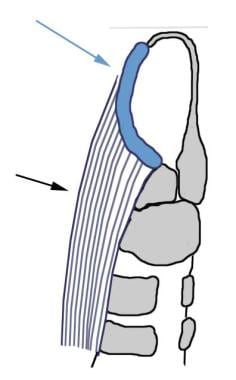 Reconstruction of the epiglottis using a hyoid bon