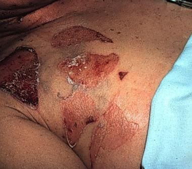 Staphylococcal scalded skin syndrome in an adult. 