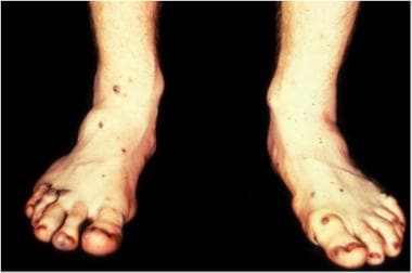 Lower extremity cutaneous lesions described in blu