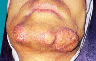 Sycosiform tinea barbae caused by trichophyton rubrum and its