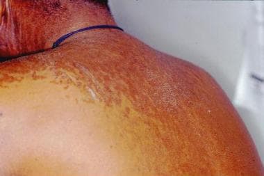 papillomatosis skin lesion