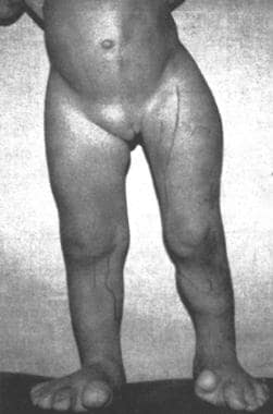 Proteus Syndrome. A: Plantar cerebriform hyperplasia B: Capillary