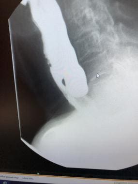 Barium swallow showing posteriorly positioned, mod