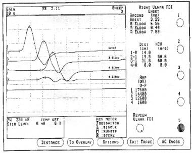 Ulnar Neuropathy Workup: Laboratory Studies, Radiography