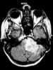 Brainstem Gliomas