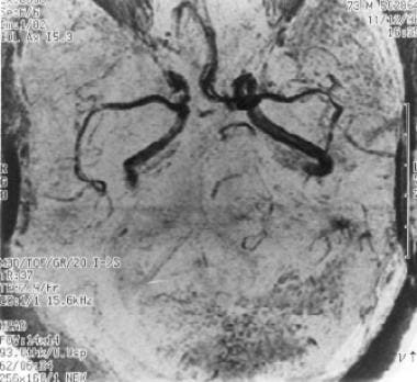 Magnetic resonance angiography demonstrating the a