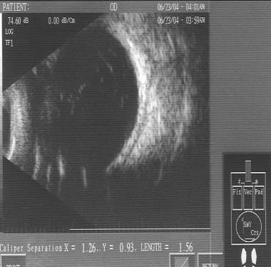 Ocular ultrasonogram of the posterior segment demo