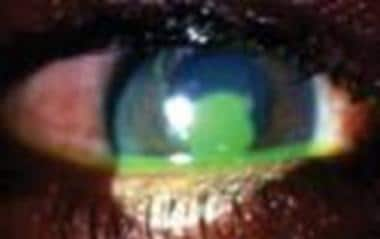 Large corneal abrasion. 