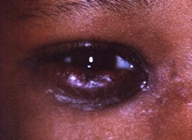 cellulitis under eye