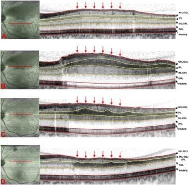 Optical coherence tomography (OCT) over time of a 