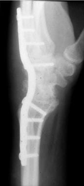 Scapholunate advanced collapse (SLAC) wrist treate