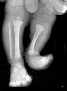Fibular hemimelia. Ball-and-socket ankle joint is 