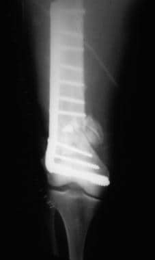 Supracondylar femur fracture treated with a dynami
