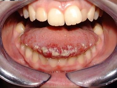 Tongue lymphatic vascular malformation. 