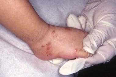 Reddish-brown papules of congenital self-healing r