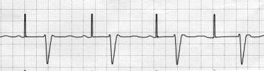Pacemaker Malfunction. Ventricular noncapture. The