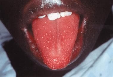 Strawberry tongue in a child with staphylococcal t