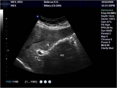 cholelithiasis ultrasound