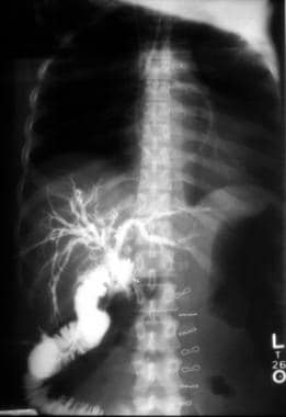 Cholangiogram showing completed choledochojejunost