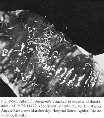 Adult hookworm attached to duodenal mucosa. 