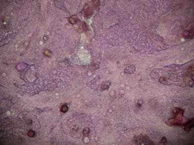 Keratotic basal cell carcinoma. Rare type characte