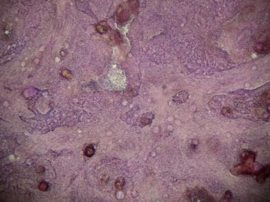 morpheaform basal cell carcinoma histology