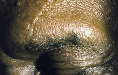 Cobblestone papules on the eyelid and papules on t