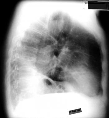 Atelectasis. Left lower lobe collapse. 