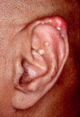 Gout. Tophaceous deposits in ear. 