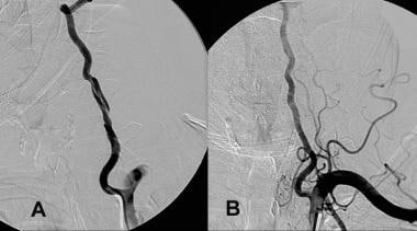 A, Dissection of the left vertebral artery seconda