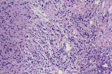 A nonspecific mixed inflammatory infiltrate that c