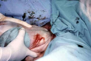 Assisted vaginal breech delivery. The fetus is rot