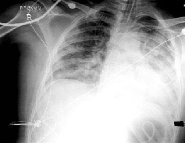 Chest radiograph in 3-year-old girl who developed 