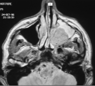 Axial MRI T1 with contrast showing tumor in the le