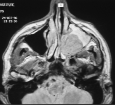 轴向MRI T1增强片示病灶