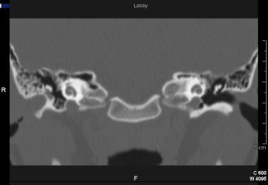 Coronal CT scan of patient with ear canal choleste