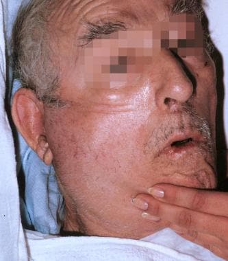 Elderly man with parotid abscess. 