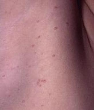 Molluscum contagiosum on the right axilla. 