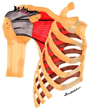 Rotator cuff tear, anterior view. 