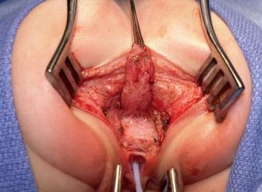 Posterior sagittal repair of rectovestibular fistu