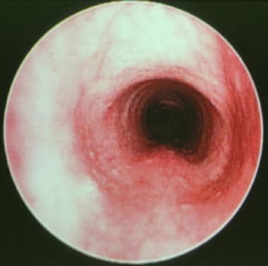 Intraoperative endoscopic view of a normal subglot