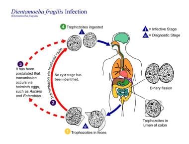 Dientamoeba Fragilis Infection Practice Essentials