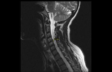 MRI of the cervical spine demonstrating disc bulge