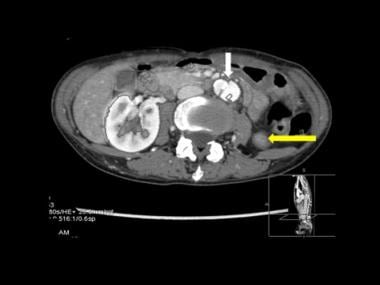 Axial CT scan through the upper abdomen in mid-des