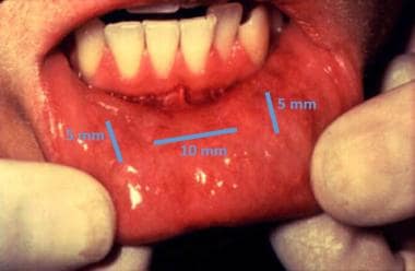 Approximate oral incision sites for placement of t