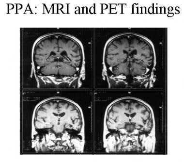 Patient with progressive nonfluent aphasia. MRI sh