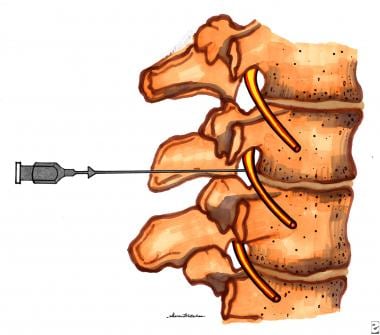 Lateral view showing needle position of lumbar par