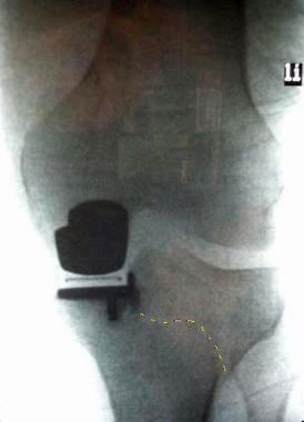 Unicompartmental knee arthroplasty. A tibial plate