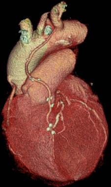 Left internal mammary artery (LIMA) graft: Volume-